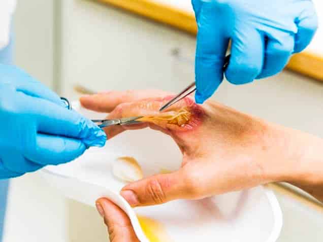 Severe Burns After Oven Explodes [2015] - 1