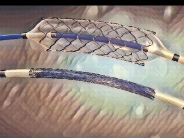 Stent and catheter for implantation into blood vessels with an empty and filled balloon