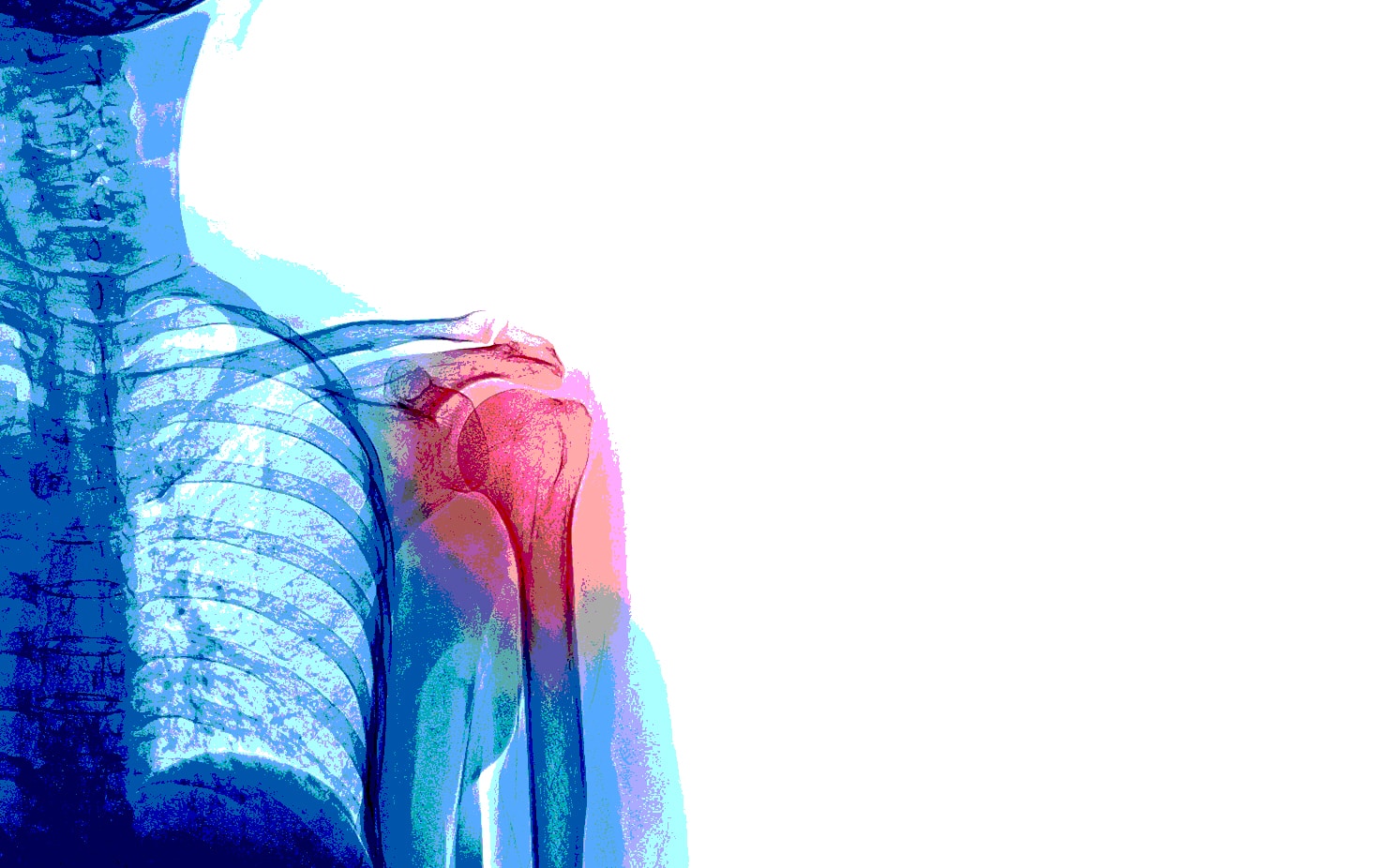 Trucker Shoulder Pain 2013